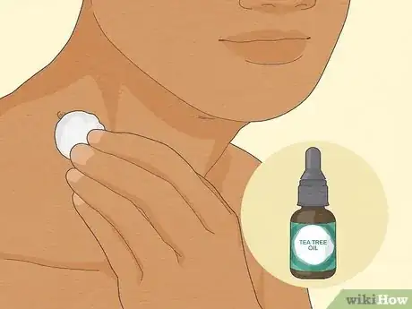 Image titled Get Rid of Skin Tags Step 3
