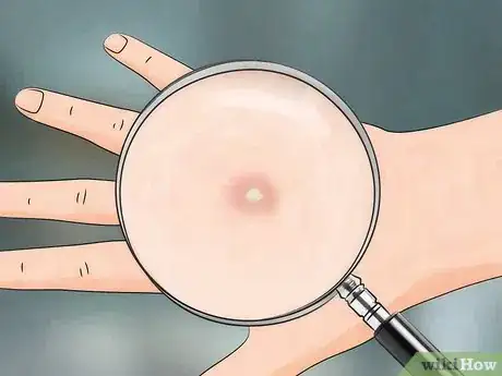 Image titled Reduce the Pain of Gnat Bites Step 10