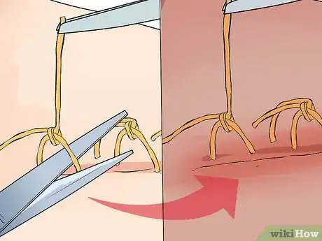 Image titled Remove Stitches Step 10