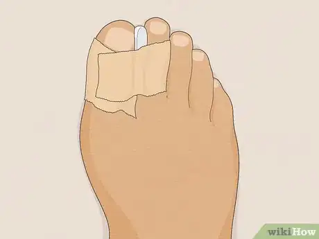 Image titled Treat a Sore Toe Step 10