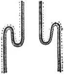 EB1911 Intestinal Obstruction - Intussusception.jpg