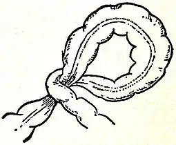 EB1911 Intestinal Obstruction - volvulus.jpg
